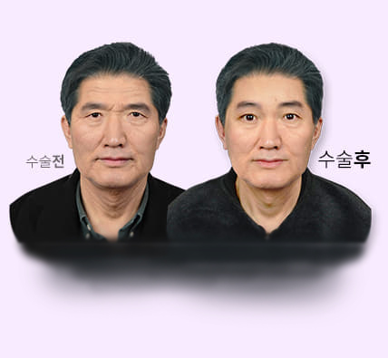 내시경 이마거상술