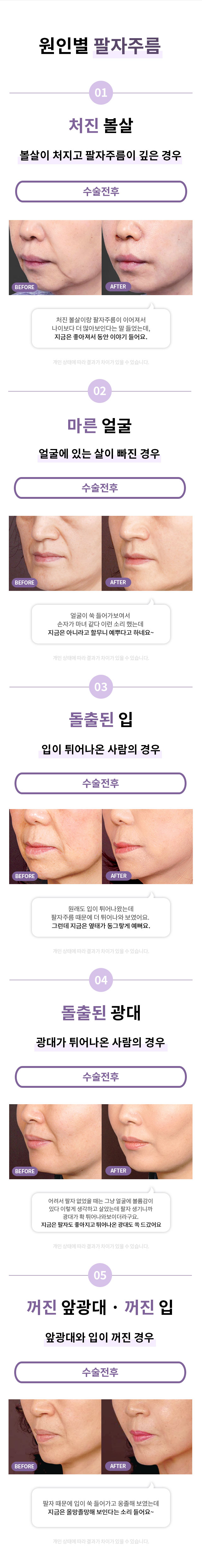 팔자주름_프로모션_페이지