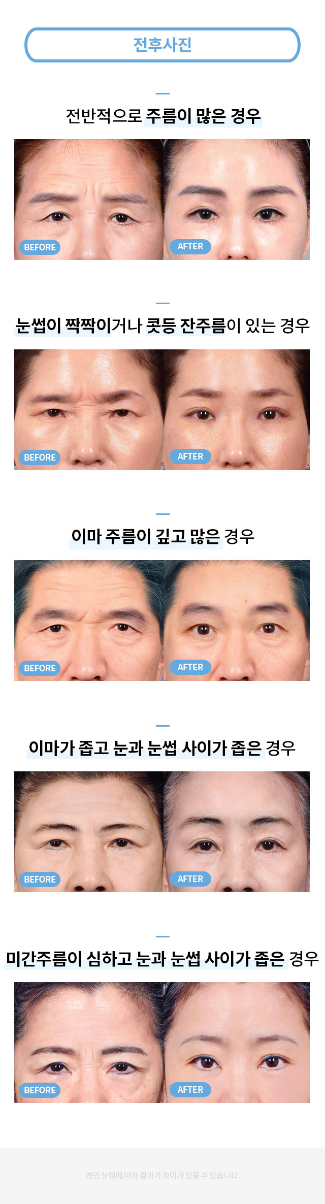 안면거상술_프로모션_페이지