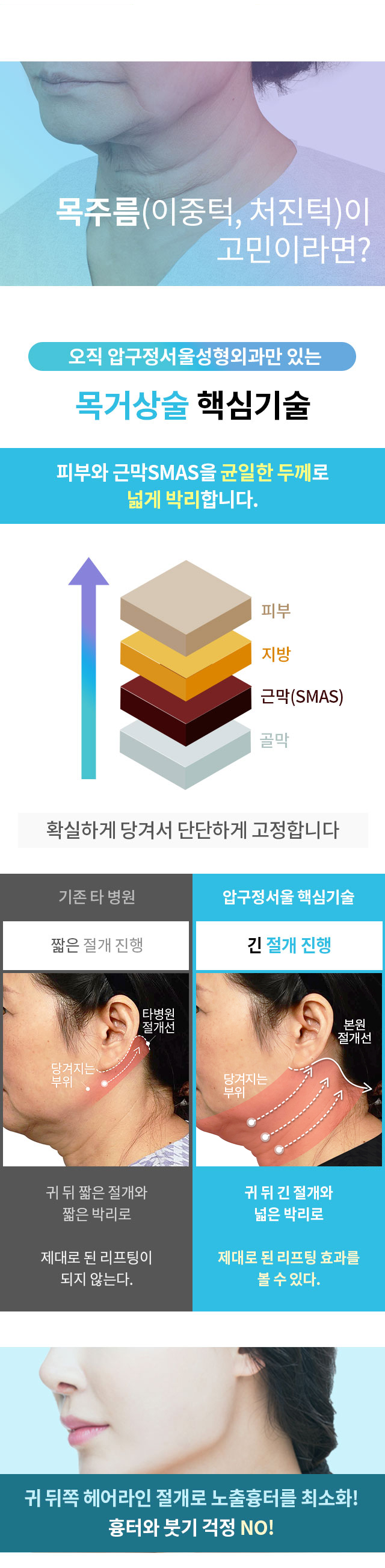 안면거상술_프로모션_페이지